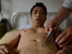 Picadas de abelhas são usadas na China em sessões de acupuntura Picadas de abelhas são usadas na China em sessões de acupuntura