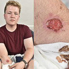 Jovem sofre suposta queimadura com iPhone 5 enquanto dormia