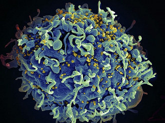 HIV (amarelo) infectando uma célula imune humana (azul).