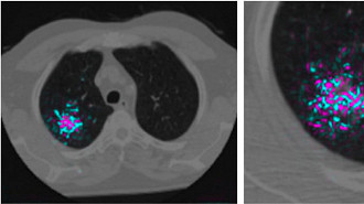 Algoritmo vai fazer com que câncer de pulmão seja detectado mais facilmente.