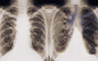 Google desenvolve algoritmo capaz de detectar câncer de pulmão