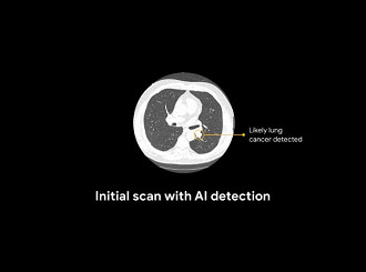 Algoritmo consegue identificar nódulos em tomografias computadorizadas.