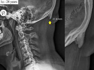 Protuberância occipital externa aumentada (EEOP)