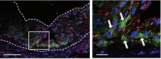 A linha pontilhada descreve a artéria aterosclerótica e o verde representa as nanopartículas, que estão na placa. O vermelho indica macrófagos, que é o tipo de célula que as nanopartículas estão estimulando para que haja a fagocitose de restos celulares . Fonte: msutoday