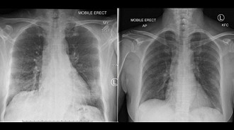 Exames de tórax mostraram os pulmões do paciente se limpando após o surgimento de células. Fonte: TheDohertyInst