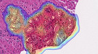 Inteligência artificial identifica câncer de próstata com alta precisão