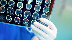 Cientistas japoneses avançam com vacina contra Alzheimer em camundongos Cientistas japoneses avançam com vacina contra Alzheimer em camundongos