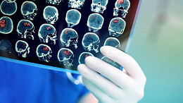 Cientistas japoneses avançam com vacina contra Alzheimer em camundongos Cientistas japoneses avançam com vacina contra Alzheimer em camundongos